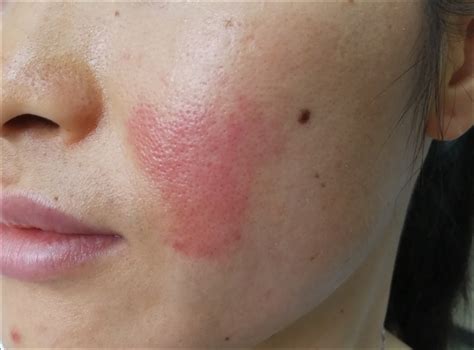 Red Sore Rash Around Lipstick | Lipstutorial.org