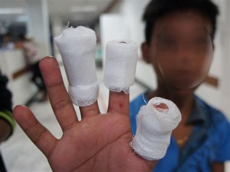 DOH records 19 firework-related injuries, 58% higher compared to 2020 ...