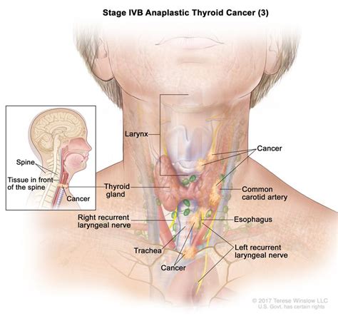 Thyroid Cancer Treatment (PDQ®)–Patient Version - NCI