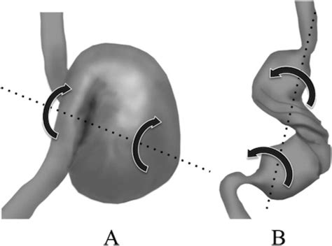 Gastric Volvulus - The Operative Review Of Surgery