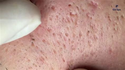 BLACKHEAD ACNES. Just Touch the Skin, So Many Acne Bounce Off...