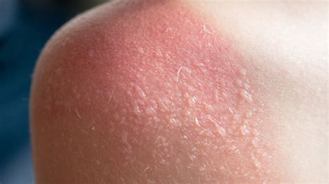 Brown Spots On Skin After Sunburn - BEST GAMES WALKTHROUGH