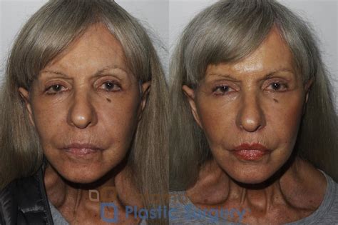 Lip Augmentation Before & After Photos Patient 174 | Washington DC ...