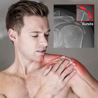 shoulder bursitis – Doctor Identity Services