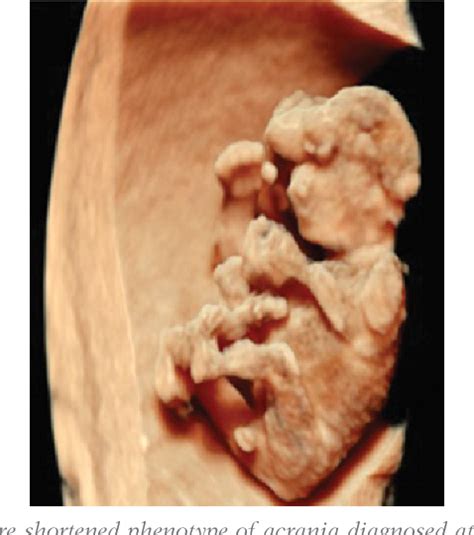 Figure 1 from Acrania-exencephaly-anencephaly sequence phenotypic characterization using two ...