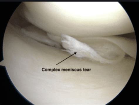 Knee meniscus cartilage tear: Orthopedic Center for Sports Medicine: Sports Medicine Physicians