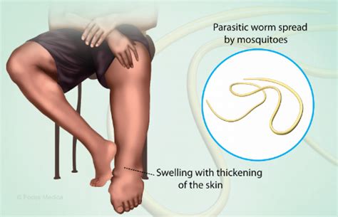 How to know Symptoms of Filariasis? - Health and Wealth - Medium