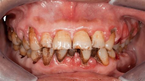 Diş Eti Çekilmesi (Periodontitis) Nedir? Nedenler, Tedavi Yöntemleri ve Önlemler - medya.com.tr