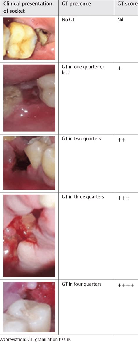 Scoring system employed for granulation tissue formation in the dry socket | Download Scientific ...