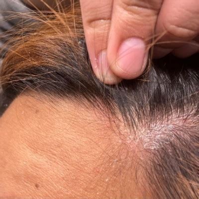 Scalp Infection: Causes, Signs, and Treatment - AHS India