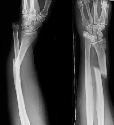 Open Fractures - Classification - Management - TeachMeSurgery