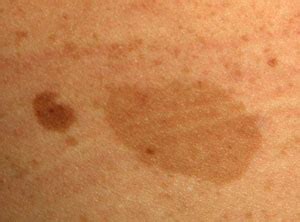 Brown Spots On Skin Causes