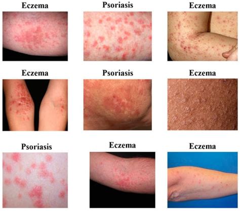 Sensors | Free Full-Text | Enhanced Deep Learning Approach for Accurate Eczema and Psoriasis ...