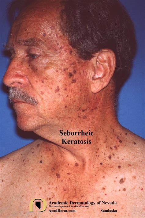 Barnacle On Skin Seborrheic Keratosis