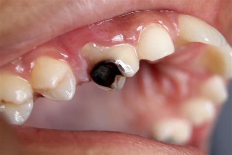 Rotten teeth: Causes, Symptoms and Treatment - Smile Studio