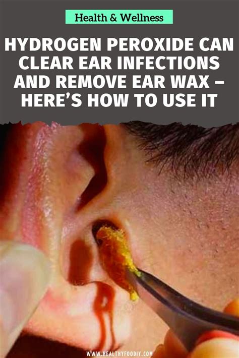 Hydrogen Peroxide Can Clear Ear Infections and Remove Ear Wax – Here’s How to Use it | Natural ...