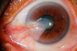 5 Eye Disorders Caused by Sun Damage - The Eye News