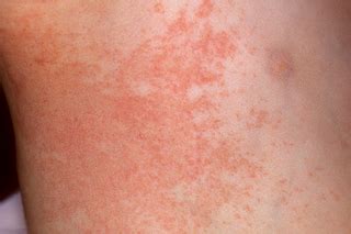 Fine Beautiful Info About How To Get Rid Of Heat Rash - Assistancecorporation