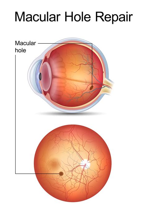 Macular Holes: How They Are Caused and Treated | Retina Associates ...