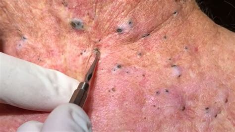 Removal Blackheads from neck Blackhead on neck - YouTube