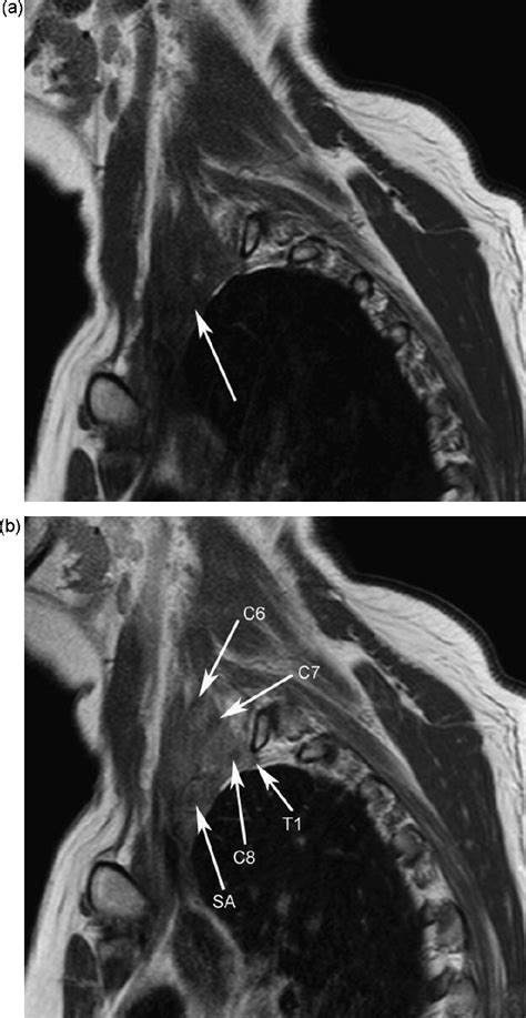 MRI of the brachial plexus: A pictorial review - European Journal of Radiology