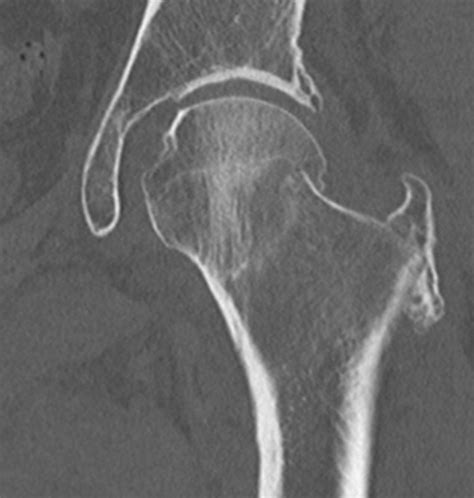 Subcapital Femoral Neck Fracture