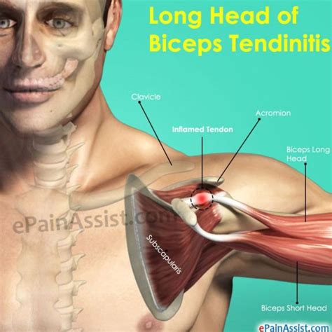 Long Head Of Biceps Tendinitis #LowerBackPain | Bicep tendonitis, Bicep tendonitis exercises ...