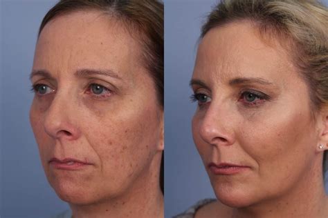 Fractional Laser Before And After, Laser Facial Before And After Emerge ...