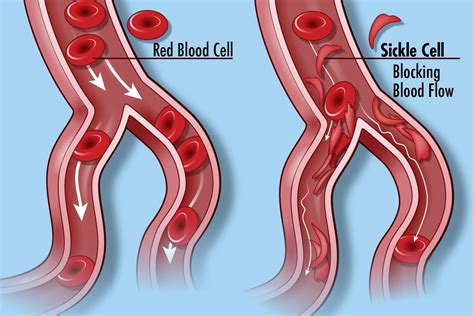 Sickle Cell Disease | Sickle cell disease (SCD) occurs in pe… | Flickr