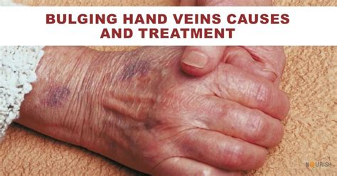 Bulging Hand Veins Causes and Treatment - NourishDoc