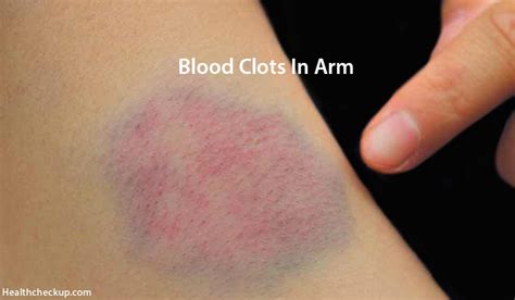 Blood Clot In Forearm