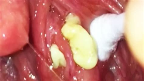 Tonsil Stone Removal Tool