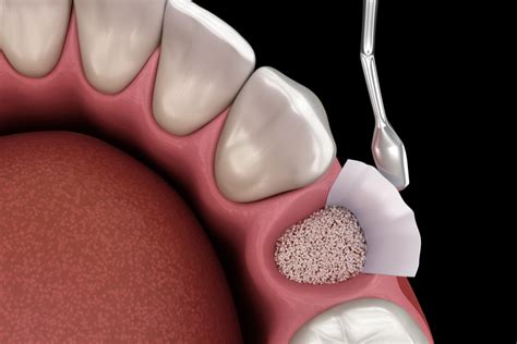 Bone Grafting | San Diego | West Coast Oral Surgery