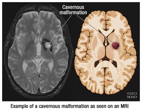 MRI of brain showing cavernous malformation | Mri brain, Mri, Brain images