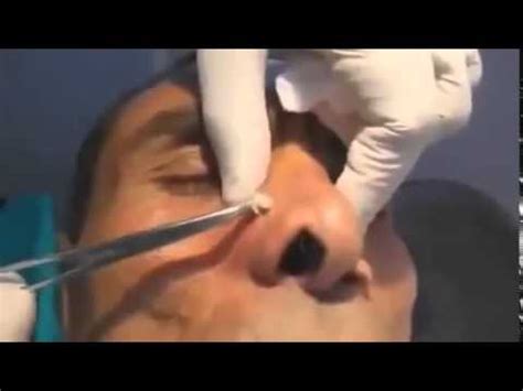 Extraction Removal of Sebaceous Cyst SCAR LESS - YouTube