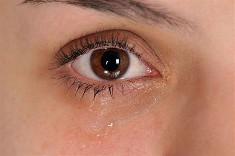 Why Do My Eyes Get Watery While Wearing Contact Lenses?