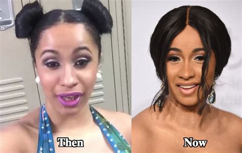 Cardi B Teeth Before After