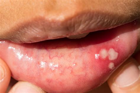 Gonorrhea Lips Symptoms | Lipstutorial.org