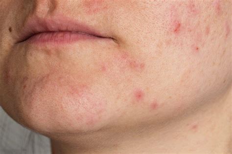 What You Need to Know About Adult Acne and 6 Ways to Treat It - Stay at Home Mum