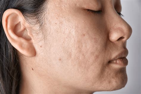 Types of Acne Scars & How to Treat Them | Dr. Dennis Gross