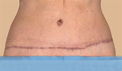 Tummy Tuck Scar: Healing, Treatment & Revision