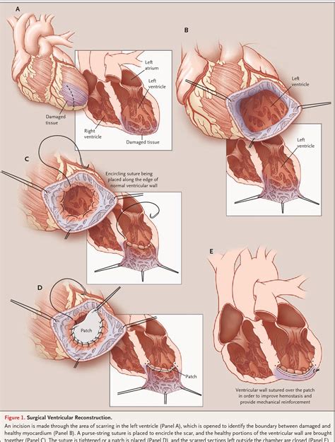 Figure 1 from Surgical ventricular reconstruction for heart failure. | Semantic Scholar