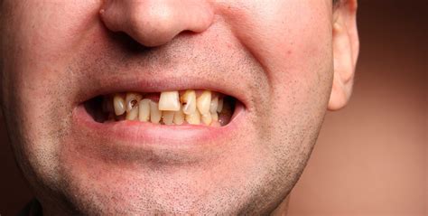 One in five Brits visit the dentist only when there's a problem with their teeth - Dentistry.co.uk