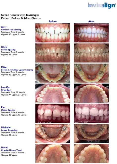 Invisalign® Results | Diamond Plus Provider in Miami, FL