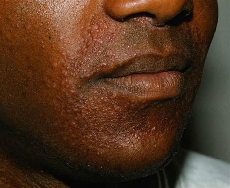 Childhood granulomatous periorificial dermatitis syn. facial Afro ...