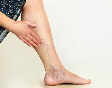 When a Leg Rash is from Vein and Vascular Issues - Precision Vascular