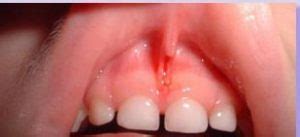 Labial Frenulum Normal