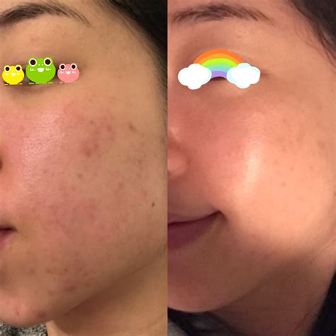 [B&A] 1 month before & after glow up using a simple routine and getting ...