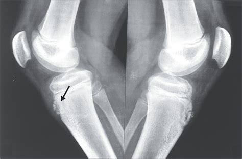 Osgood–Schlatter Disease | NEJM