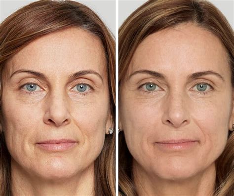 Rid Your Face of Smile Lines with Sculptra Aesthetic | The Skin Clinic Scottsdale